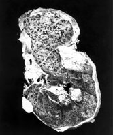Image: A whole lung showing scarring from the inhalation of asbestos fibres